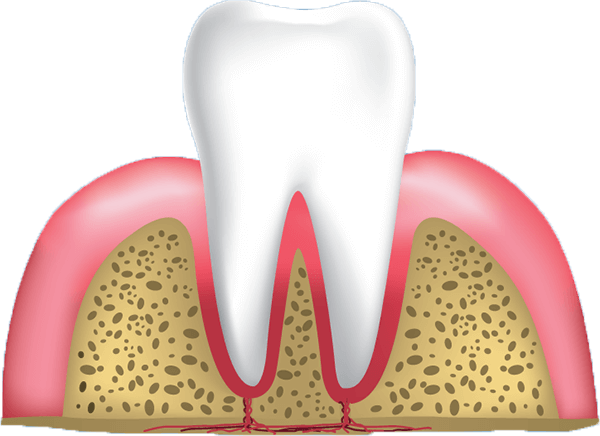 gum disease stage 1