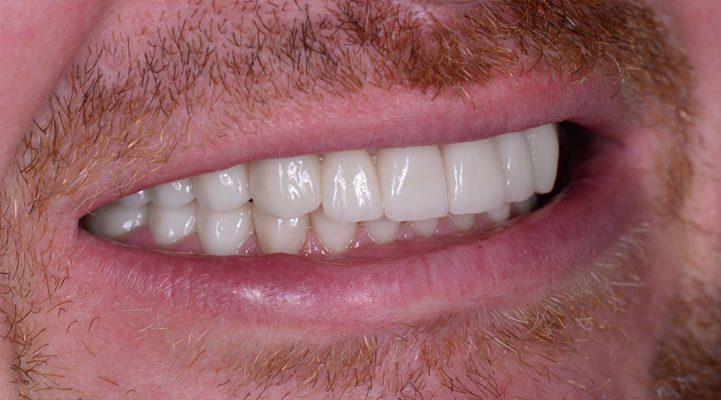 Full Mouth Dental Implants | Chicago, IL | Millennium Periodontics